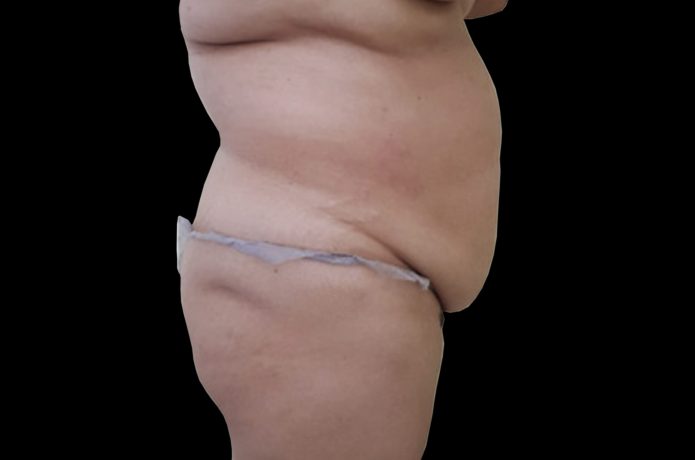 Antes barriga lateral