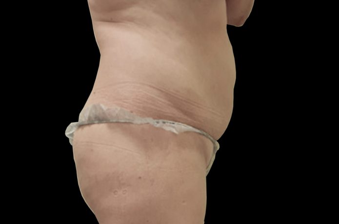 despues barriga lateral